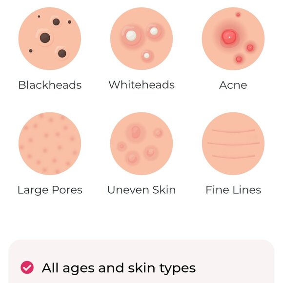 Blackheads Treatment Kit 2.0 by Luxury Confidence - Picture 2 of 5